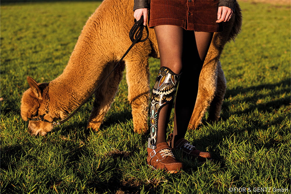 A woman with a lower leg orthosis stands next to an alpaca in a meadow